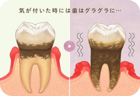 気が付いた時には歯はグラグラに