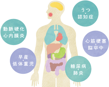 動脈硬化・心内膜炎・早産・低体重児・糖尿病・肺炎・心筋梗塞・脳卒中・うつ・認知症