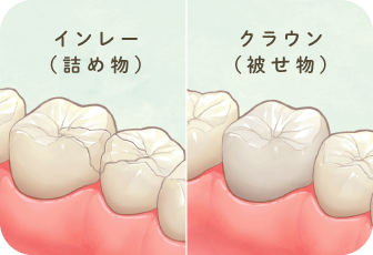 インレー（詰め物）クラウン（被せ物）